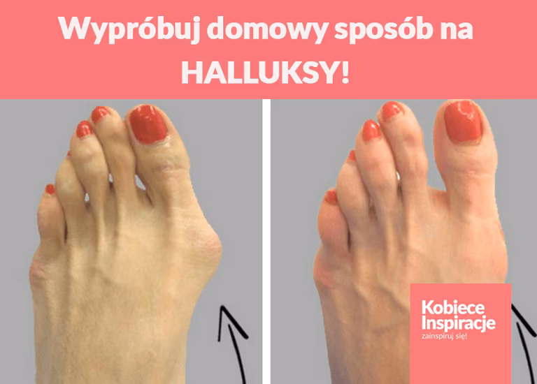 Wypróbuj domowy sposób na HALLUKSY!