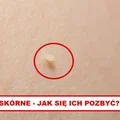 TAGI SKÓRNE – Zobacz jak się ich pozbyć