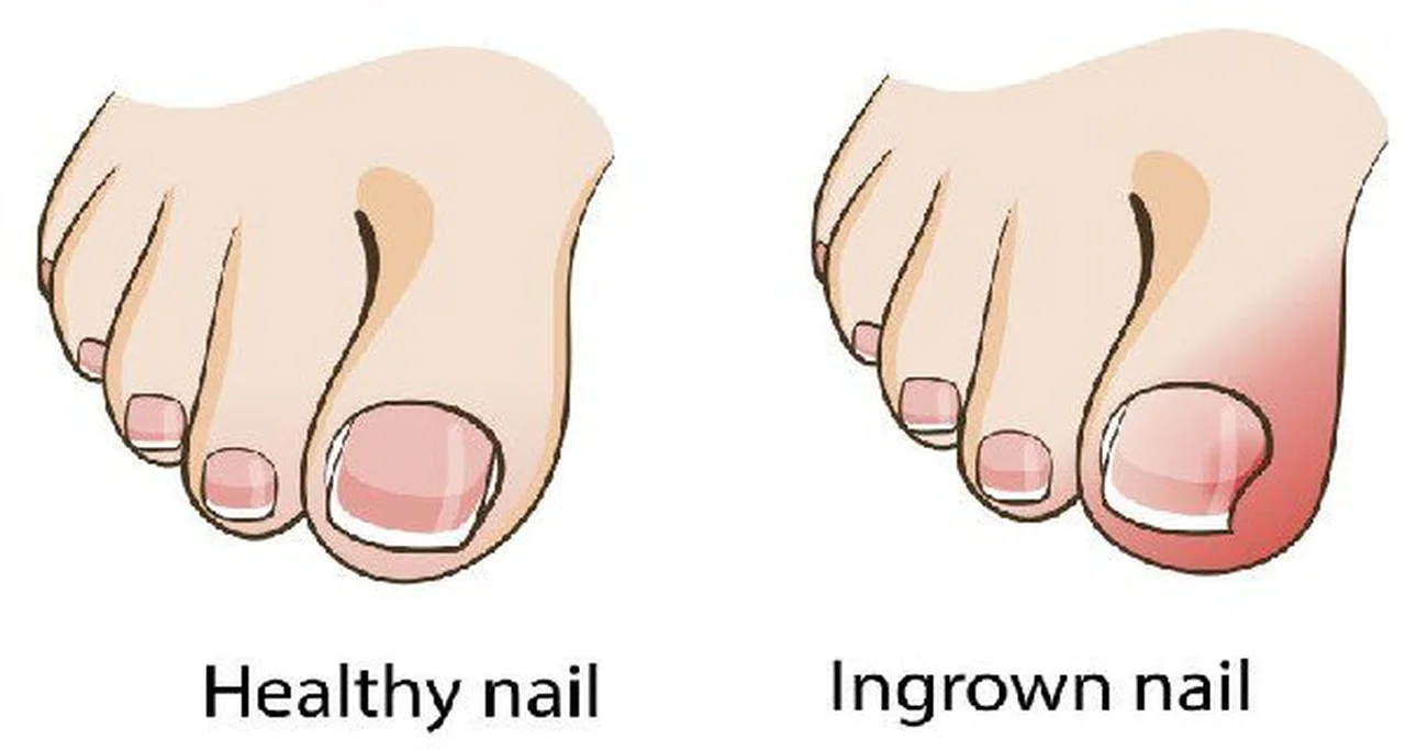 Pozbądź się problemu wrastającego paznokcia