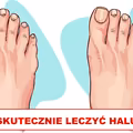 Masz HALUKSY? Sprawdź jak sobie z nimi radzić!
