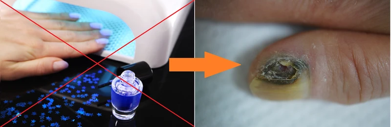 Czy manicure hybrydowy może powodować czerniaka?