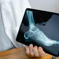 Międzynarodowy Dzień Świadomości Fibrodysplasia Ossificans Progressiva (FOP)