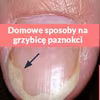 Domowe, skuteczne sposoby na leczenie grzybicy paznokci
