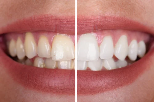 Biały uśmiech bez wizyty u dentysty? Odkryj sekretny składnik z Twojej kuchni!