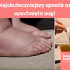 Najskuteczniejszy sposób na opuchnięte nogi