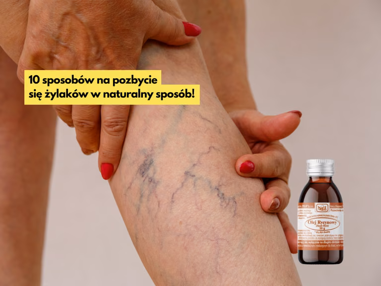 10 genialnych metod na pozbycie się żylaków w naturalny sposób!