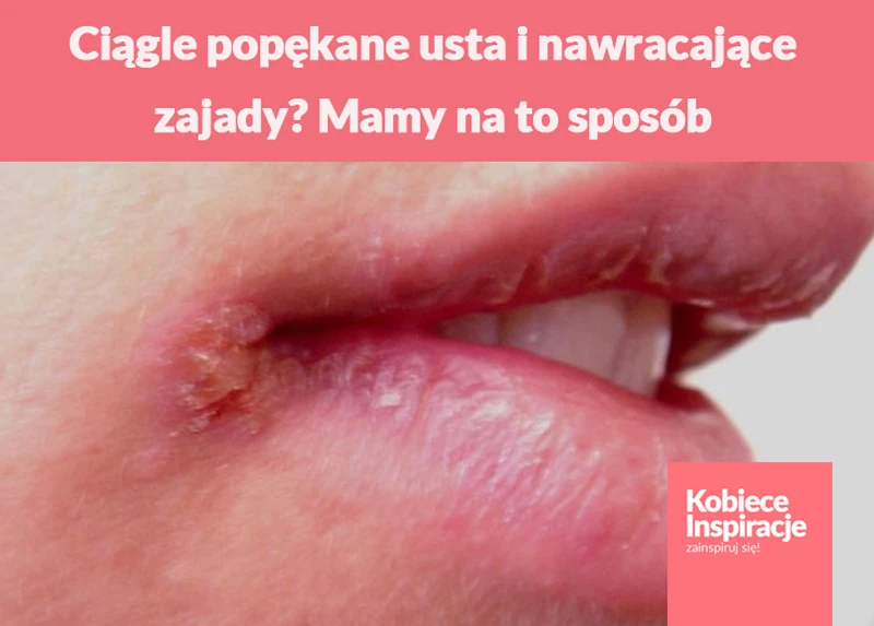Ciągle popękane usta i nawracające zajady? Mamy na to sposób