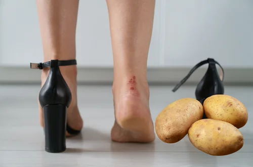 Włóż ziemniaka do butów i czekaj na efekt! Twoje stopy ci podziękują!