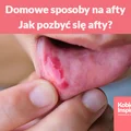 Domowe sposoby na afty - jak pozbyć się afty?