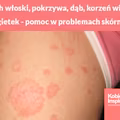 Orzech włoski, pokrzywa, dąb, korzeń wierzby i nagietek - Twoja pomoc w problemach skórnych