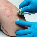 Międzynarodowy Dzień Łuszczycy: Zrozumieć i wspierać osoby dotknięte chorobą