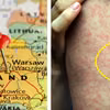 Nowe ognisko odry w Polsce. Jakich objawów nie wolno ignorować?