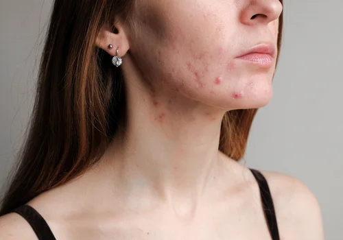 Dlaczego nagle masz więcej pryszczy? Wiosna ma na to wpływ