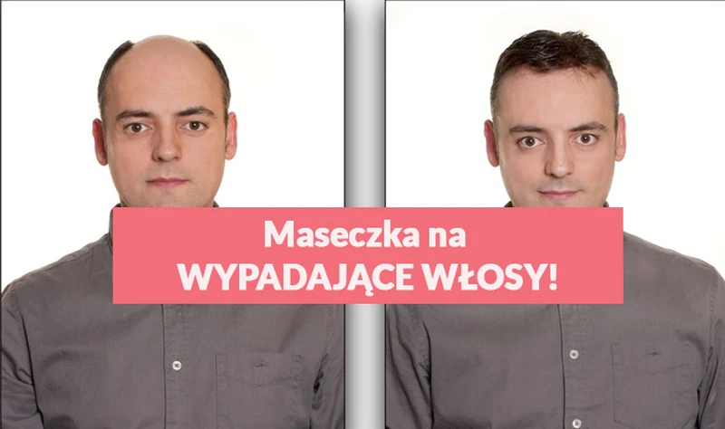Wypróbuj najbardziej skuteczną maseczkę na WYPADAJĄCE WŁOSY!