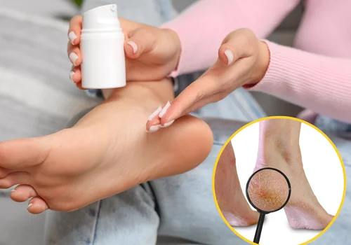 Szorstkie pięty? Ten krem na odparzenia dla niemowląt działa jak najlepszy peeling!