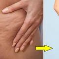 Masz cellulit? Nie jesteś na niego skazana! Sprawdź, jak z nim walczyć
