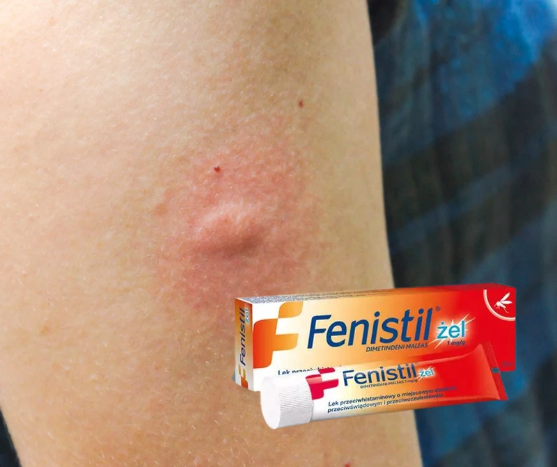 10 zastosowań Fenistil żelu. Działa bardzo szybko i przynosi znaczną ulgę.