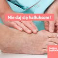 Ćwiczenia, które pomogą Ci zapobiec oraz złagodzić haluksy.