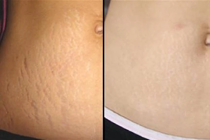 Skuteczny peeling na rozstępy - tylko dwa składniki!
