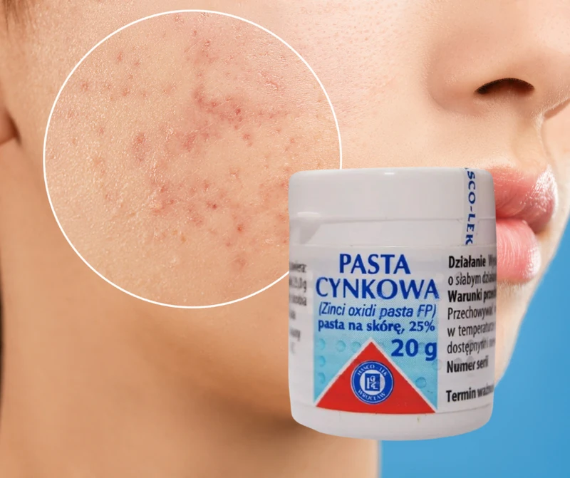 Pasta cynkowo- HIT z apteki za 5 zł!