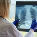 Światowy Dzień Przewlekłej Obturacyjnej Choroby Płuc: Znaczenie i Świadomość