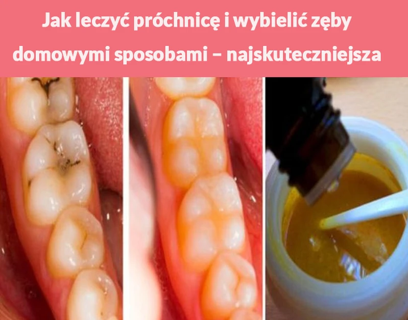 Jak leczyć próchnicę i wybielić zęby domowymi sposobami – najskuteczniejsza metoda