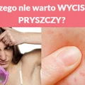 Dlaczego nie warto WYCISKAĆ PRYSZCZY?