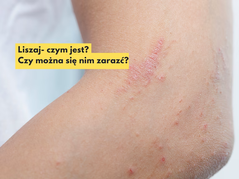 Masz takie znamię na skórze? Sprawdź czym jest liszaj i jak go wyleczyć?