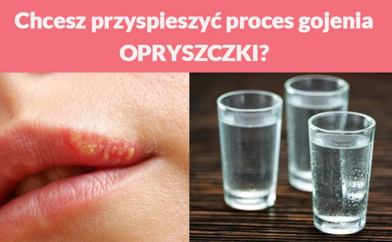 Chcesz przyspieszyć proces gojenia OPRYSZCZKI?