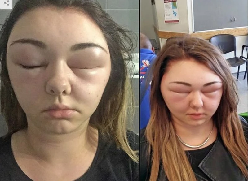 Jedna wizyta u fryzjera sprawiła, że prawie oślepła! Wina fryzjerki?