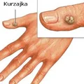 Jak pozbyć się kurzajek domowym sposobem?