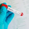 Światowy Dzień Malarii: Walka z Globalnym Zagrożeniem