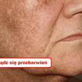 Naturalne sposoby na PRZEBARWIENIA NA SKÓRZE