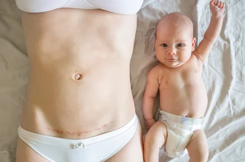 Ile można mieć cięć cesarskich? Czy możliwy jest naturalny poród po cesarce?