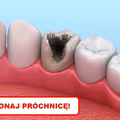 Zobacz jak samemu zwalczyć PRÓCHNICĘ!