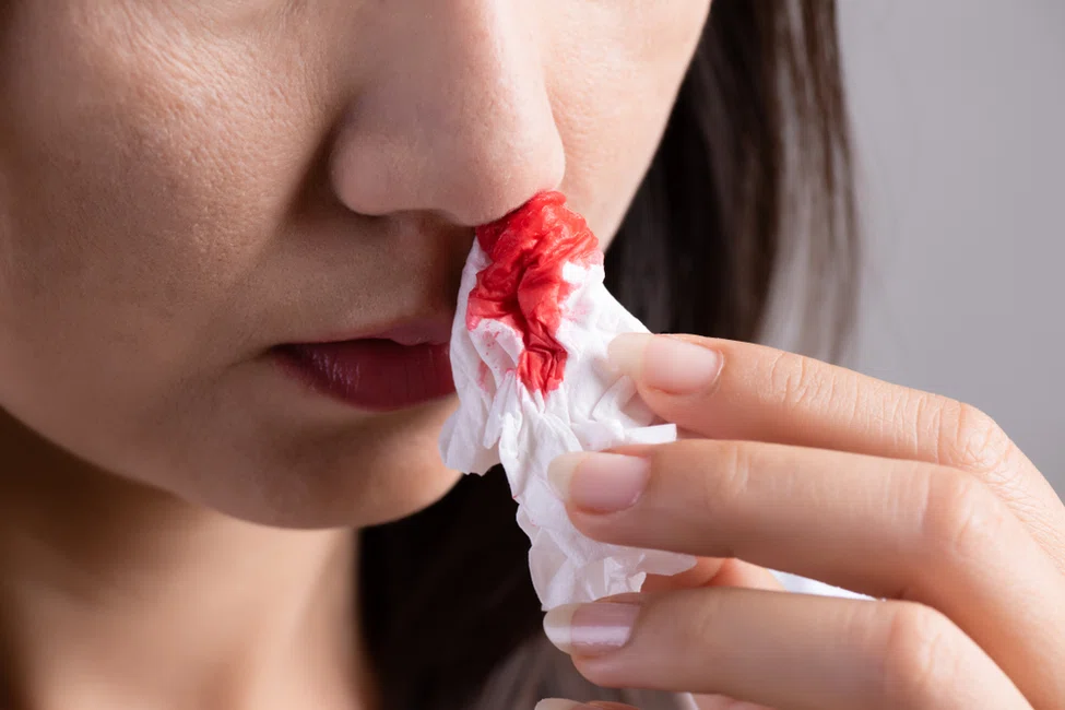 Krwawienie z nosa - jakie mogą być jego przyczyny?