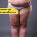 Lipodemia, czyli choroba grubych nóg. Jakie są przyczyny i jak ją leczyć?