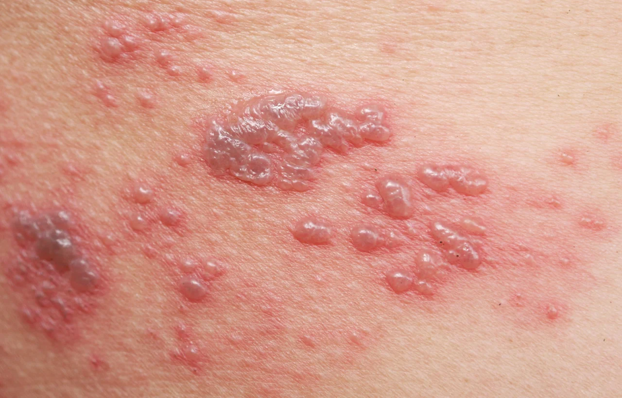 Alergia na zimno- czy to możliwe? Przekonaj się robiąc test