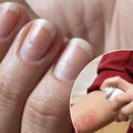 Ten preparat na oparzenia sprawia, że paznokcie rosną szybciej!