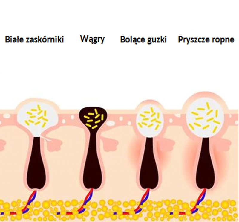 4 rodzaje pryszczy i sposoby na radzenie sobie z nimi