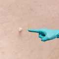 Włókniaki na skórze: czy można je usuwać w domu? Lekarze ostrzegają przed popularną metodą