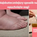 Najskuteczniejszy sposób na opuchnięte nogi