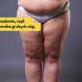 Lipodemia, czyli choroba grubych nóg. Jakie są przyczyny i jak ją leczyć?