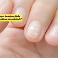 O czym świadczą białe plamki na paznokciach? Sprawdź, czy sama ich nie masz!