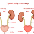 Lista 9 sposobów na wyleczenie zapalenia pęcherza