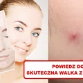 Dokuczają Ci PRYSZCZE? Wypróbuj domowe sposoby!