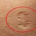 Posiadasz taką bliznę po szczepieniu na ramieniu? Dowiedz się, jaka jest jej przyczyna