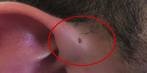 Znasz kogoś, kto ma taką dziurkę na uchu? Zobacz,co ona oznacza!
