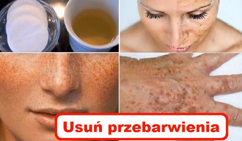 Sprawdź najlepsze domowe MASECZKI na PRZEBARWIENIA