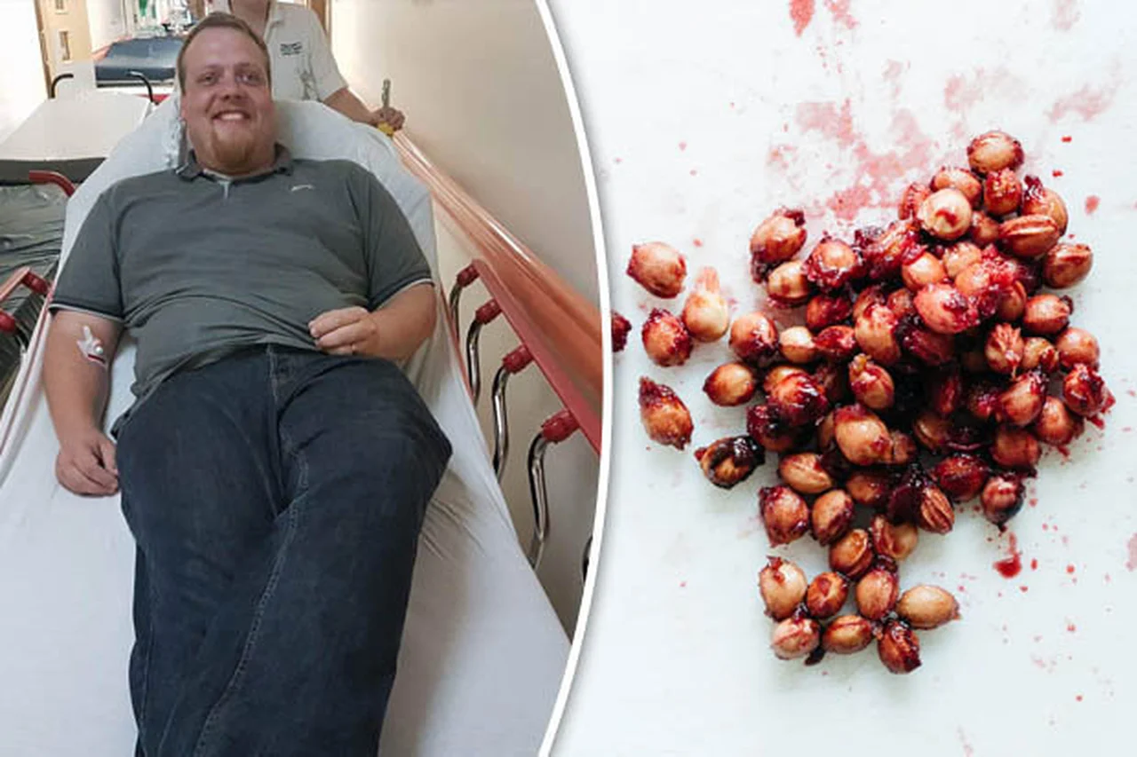 Ten mężczyzna prawie umarł po zjedzeniu 3 pestek wiśni